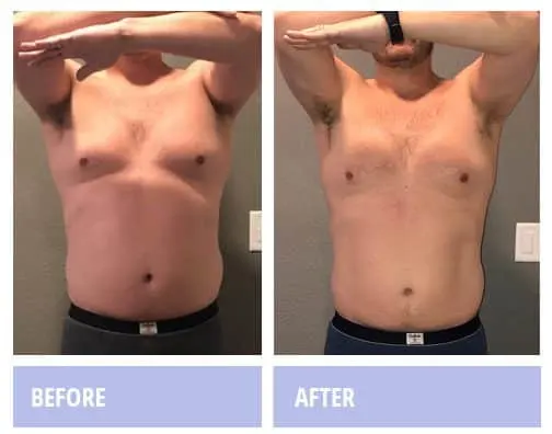 Man, front view, before and after a Zerona course