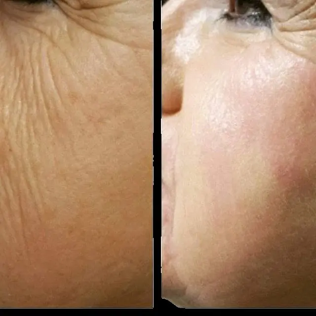Facial pigmentation before and after Plexr Plus resurfacing