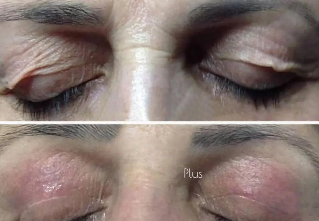 Upper eyelid before and after Plexr Plus plasma treatment